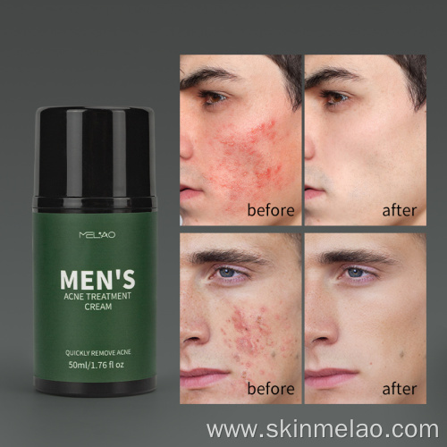 Moisturizing Anti Aging Men's Acne Treatment Cream